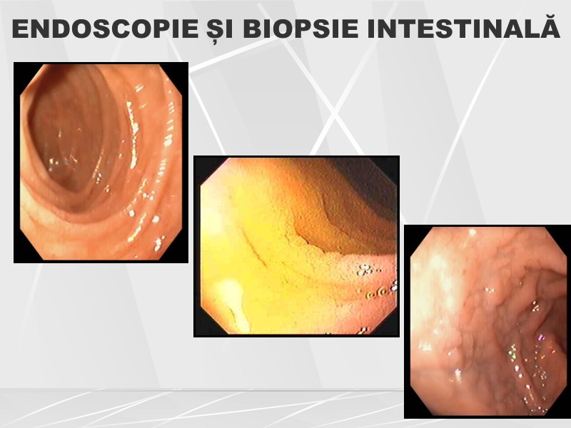 ENDOSCOPIE ȘI BIOPSIE INTESTINALĂ